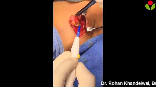 Axilary Lymph Node Biopsy and Sentinel Lymph Node Biopsy For Breast Cancer - Lazoi.com смотреть онлайн