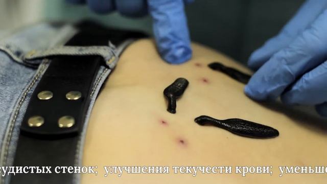 Гирудотерапия