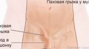 Паховая грыжа у мужчин   симптомы   профилактика