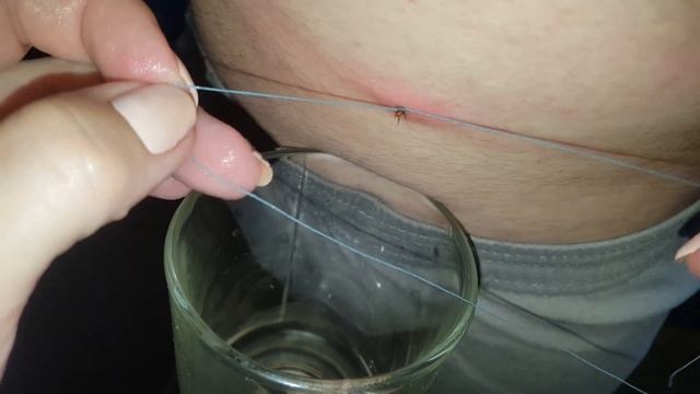 Клещ. Как вытащить клеща ниткой за 1 минуту. Tick Bite. После отпустили клеща на улицу :)