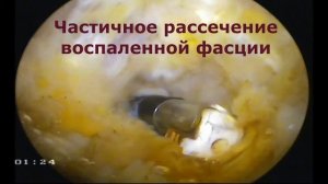 Хирургическое лечение подошвенного фасциита («пяточной шпоры»)