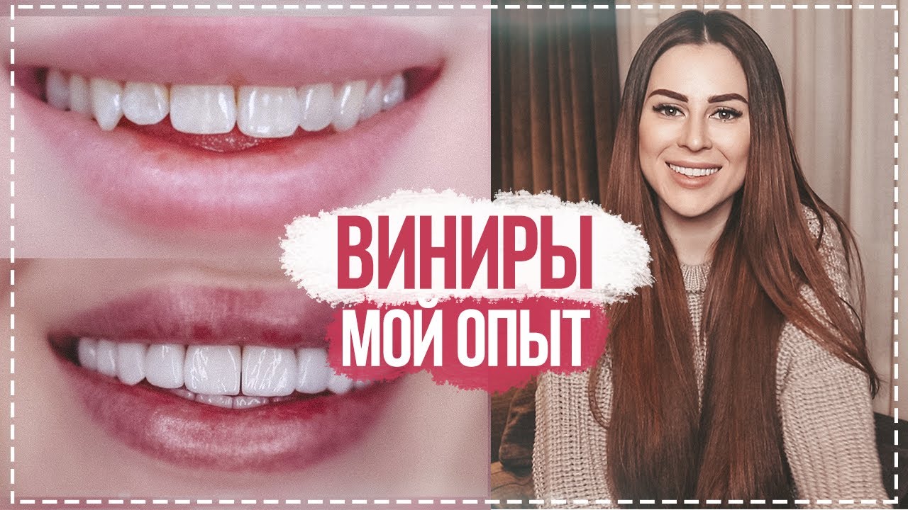 ВИНИРЫ | МОЯ ИСТОРИЯ | КАК ИЗМЕНИЛАСЬ МОЯ ЖИЗНЬ смотреть онлайн