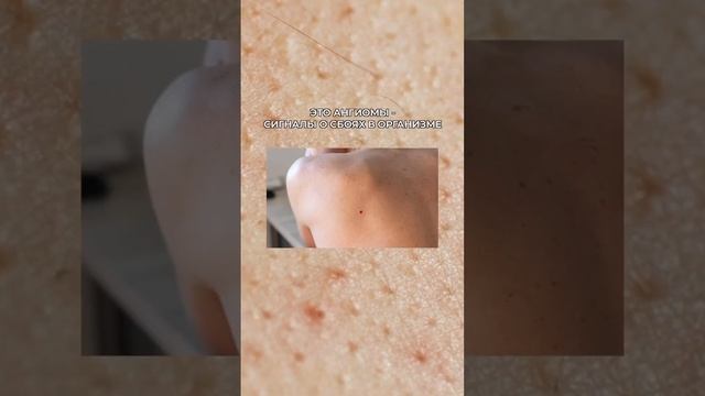 Стоит ли бояться красных родинок на теле? На вопрос ответит Аня??♀️, косметолог команды Glatte смотреть онлайн