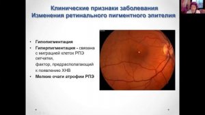 Этиология и патогенез возрастной макулярной дегенерации. Часть1.mp4