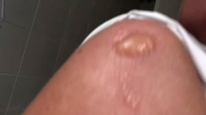 Вот такие волдыри на плече ! Это всё из-за Солнца!