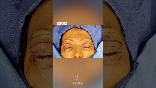 Eyelid Surgery Before & After | Dr. Johnson C. Lee | Beverly Hills, CA смотреть онлайн