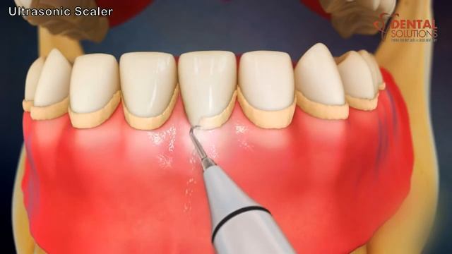 Ultrasonic Scalers: Clinical Use and Benefits смотреть онлайн