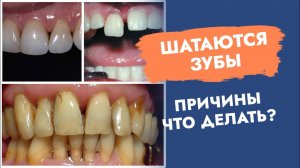 Шатаются зубы. Причины. Что делать?