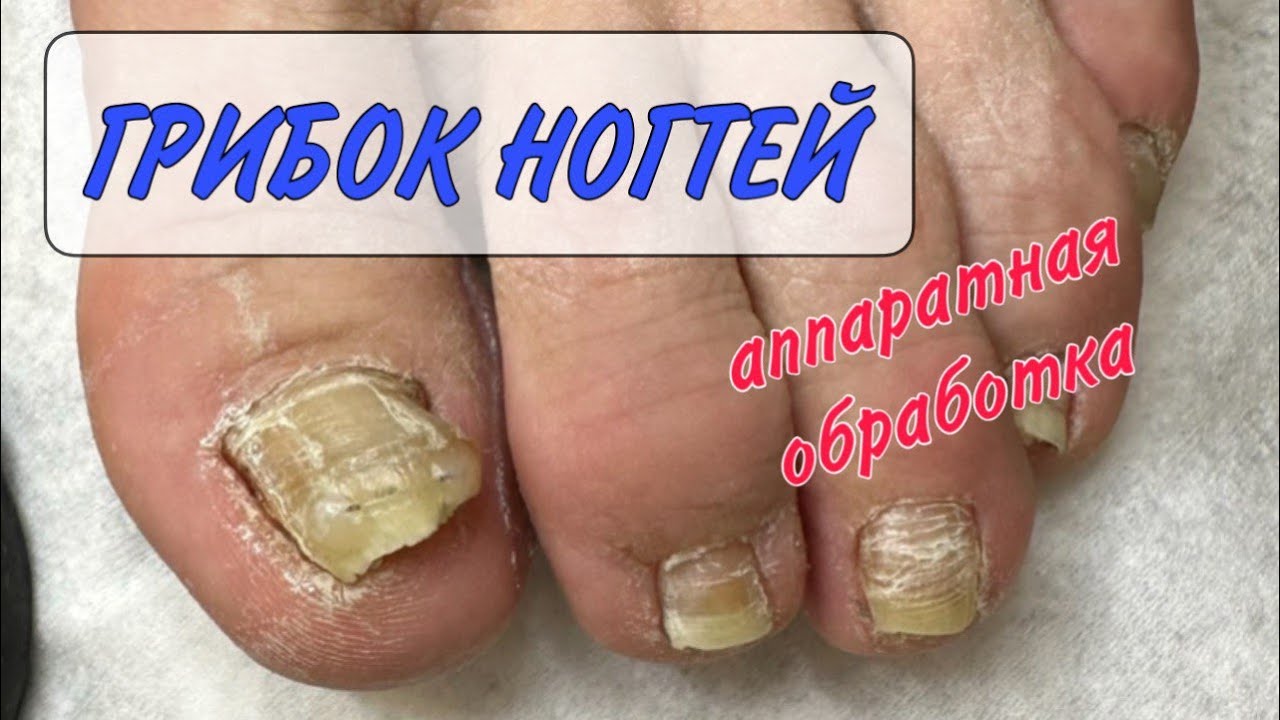 Медицинский педикюр/ грибок ногтей/ педикюр у подолога смотреть онлайн