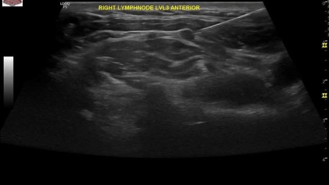 Lymph node evaluation in patient with history of papillary thyroid cancer by Dr Sean Nikravan, MD смотреть онлайн