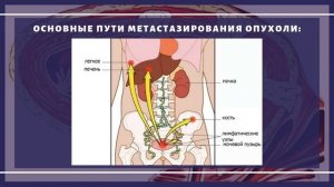 Первые симптомы рака мочевого пузыря