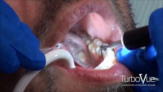 TurboVue® Illuminated Magnetostrictive Ultrasonic Scaler by Parkell смотреть онлайн
