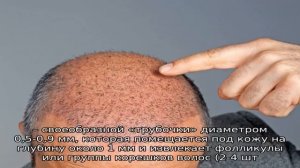 Как проводится процедура пересадки волос методом HFE?