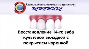 Восстановление 14 го зуба культевой вкладкой с покрытием коронкой