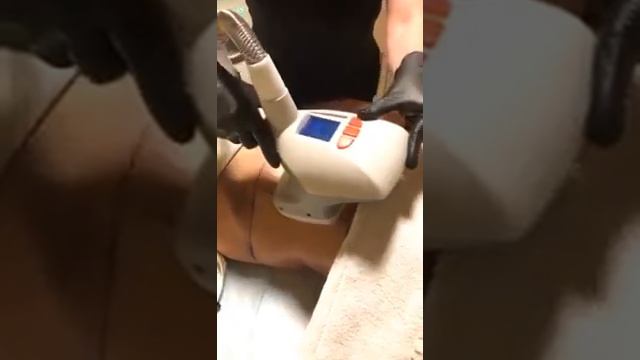 Velashape For Abdomen In Russian