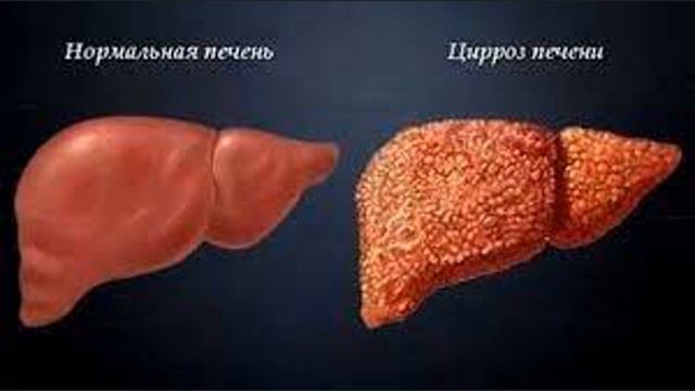 Психосоматика печени: Цирроз печени смотреть онлайн