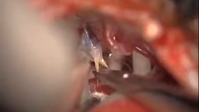 Невралгия тройничного нерва 3 смотреть онлайн