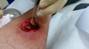 Иссечение некроза кожи при ожоге 4 степени.