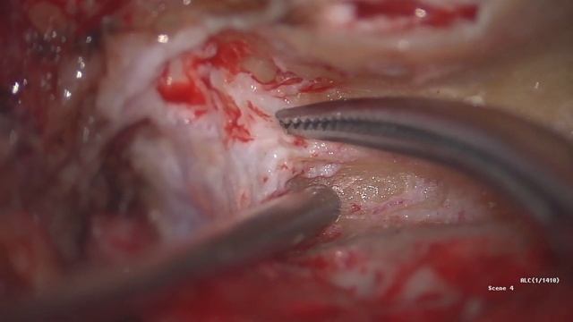 Lateral temporal bone resection (LTBR) with facial nerve sacrifice смотреть онлайн