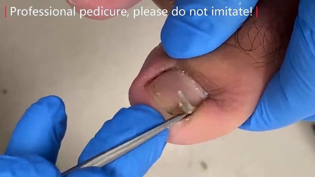 Pedicure Tutorial: Removing Dirt Under Toenails【Xue Yidao】