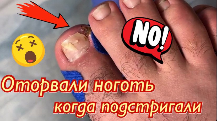 Оторвали ноготь когда подстригали ?⚠️?❗️?? смотреть онлайн
