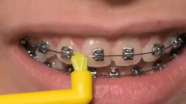 Уход за брекетами. Как чистить брекеты? монопучковая щётка Curaprox Solo. смотреть онлайн