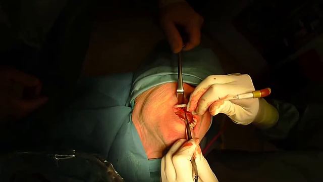 Установка имплантов #Nobel Biocare смотреть онлайн