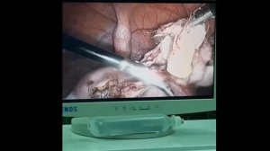 Лапароскопия. Дермоидная киста (тератома). Laparoscopy. Dermoid cyst (teratoma)皮样囊肿（畸胎瘤)