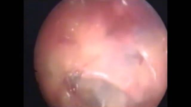 Minimal Access Surgery for Sentinel Lymph Node Excision for Ca Breast смотреть онлайн