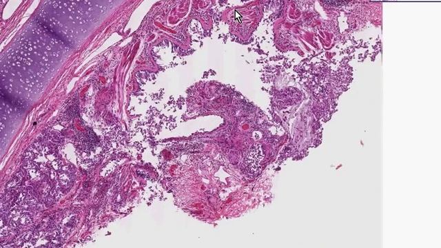 Histopathology Lung, lymph node --Asthma смотреть онлайн