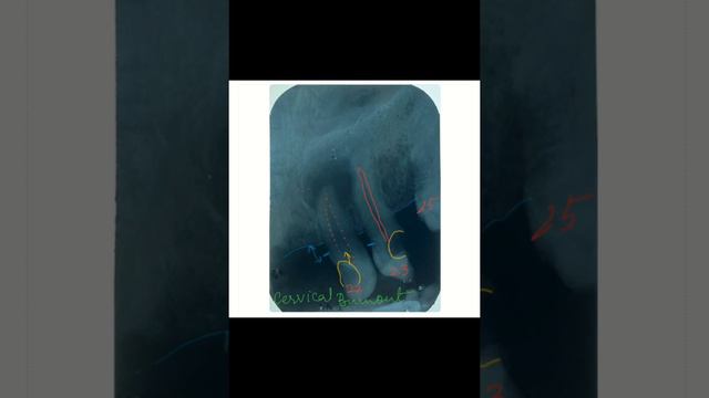 Radiographic interpretation made easy case 10 - Expert and student conversations смотреть онлайн