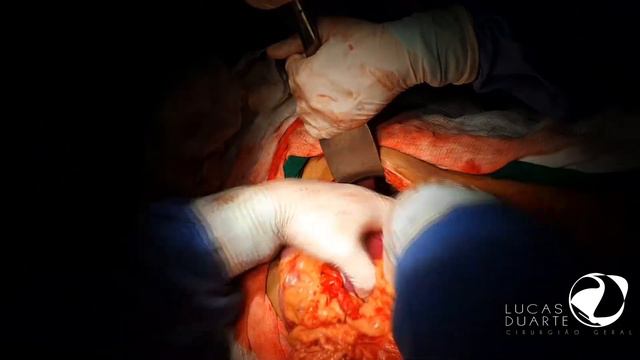 DR. LUCAS DUARTE • SPLENECTOMY - Esplenectomia [20AGO21] смотреть онлайн