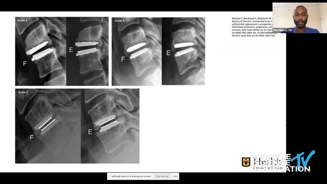 Cervical Artificial Disc Replacement (C-ADR)- Ravi Nunna, M.D. смотреть онлайн