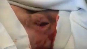 Гидраденит    hydradenitis