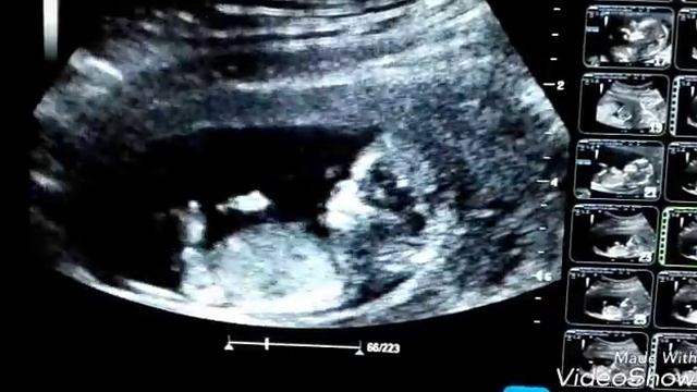 Узи 12-13 недель смотреть онлайн