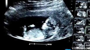 Узи 12-13 недель