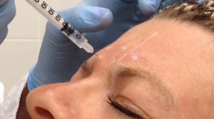 Отработка студентов по БОТОКСУ. Область межбровья: процерус и корругатор.