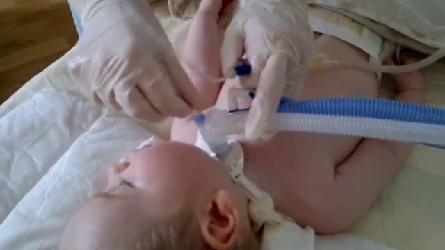 Санация трахеостомы и полости рта смотреть онлайн