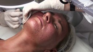 Сколько длится эффект от биоревитализации