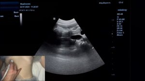 Узи для начинающих. Урок "УЗИ желчного пузыря"