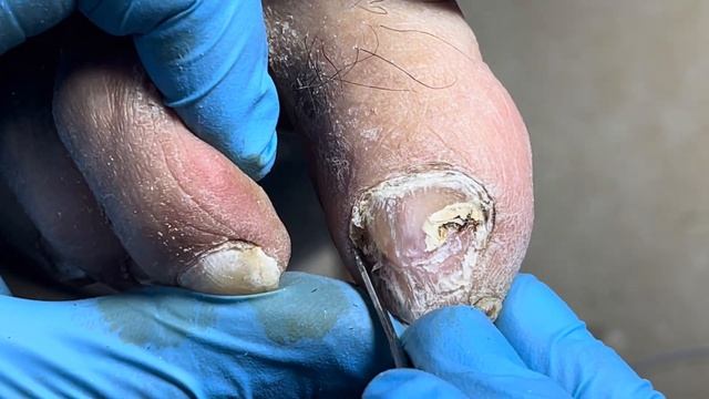 Nails are broken, remove hard impurities and germs【Pedicure Master Lin Jun】 смотреть онлайн