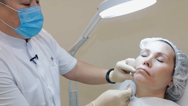 Коррекция носогубных складок филлером на основе гиалуроновой кислоты