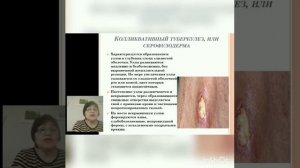 Классификация туберкулеза  Туберкулез ротовой полости, клиническое течение и диагностика