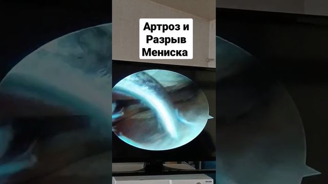 Артроз коленного сустава и разрыв Мениска смотреть онлайн