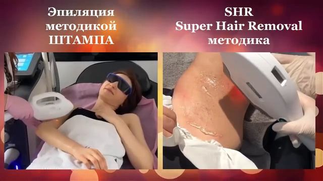 Отличие методик лазерной эпиляции SHR и штампа - Лазерная эпиляция, элос и фотоэпиляция в Краснодар смотреть онлайн