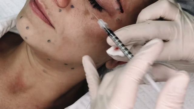 БОТУЛОТОКСИН смотреть онлайн