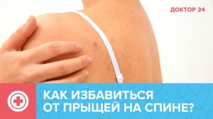 Из-за чего появляются ПРЫЩИ на спине? Как от них избавиться? | Доктор 24