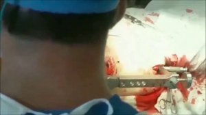 интрамедулярни штифт бедренной кости проксимальной доступ. Intramedullar osteosintezi.استئوسنتز БИО