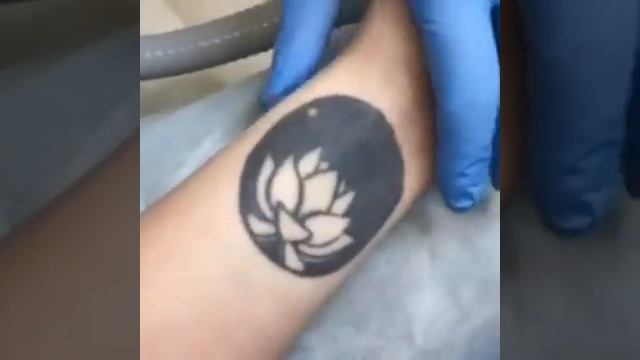 Удаление татуировки лазером. смотреть онлайн