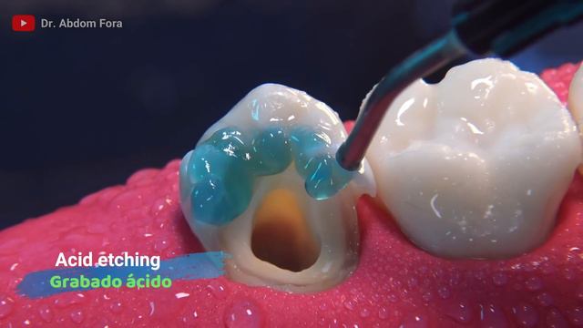 Es Posible Salvar Un Diente Con Caries Extensa?